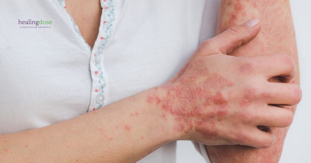 Quinacrine for Lupus Skin Symptoms: A Compounded Option From Experts at Michigan Compounding Pharmacy