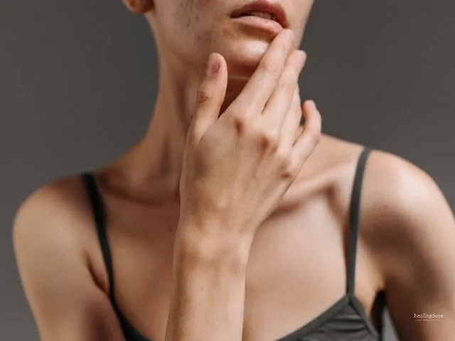 tranexamic-acid-on-melasma