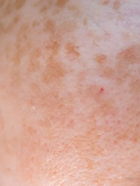Melasma skin
