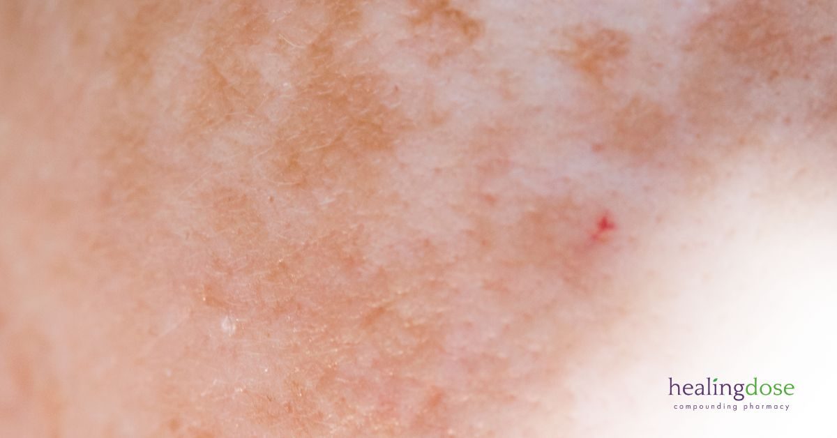 Featured-Image-Woman_with_Melasma