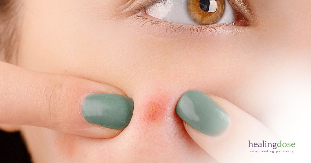 Compounding pharmacy for acne, dermatology. Lifestyle recommendations and medicated creams and supplements.