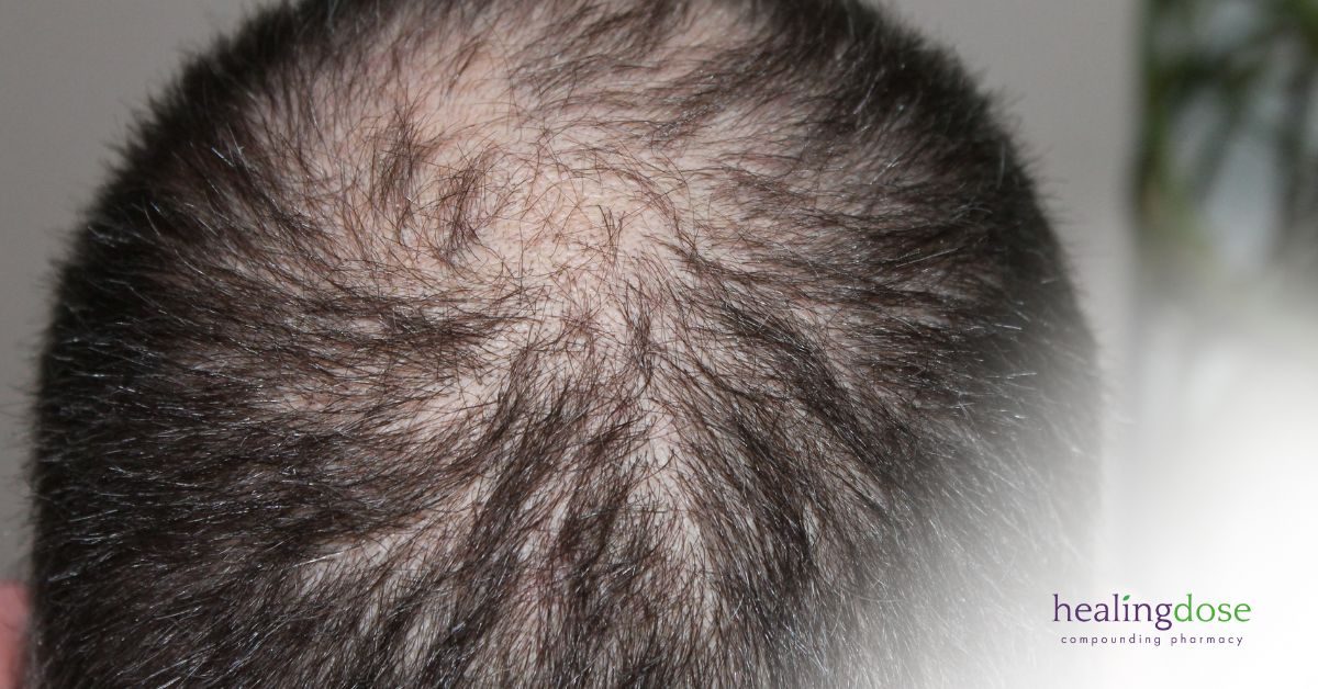androgenic-alopecia-hair-growth-medication-supplements-vitamins-michigan-compounding-pharmacy
