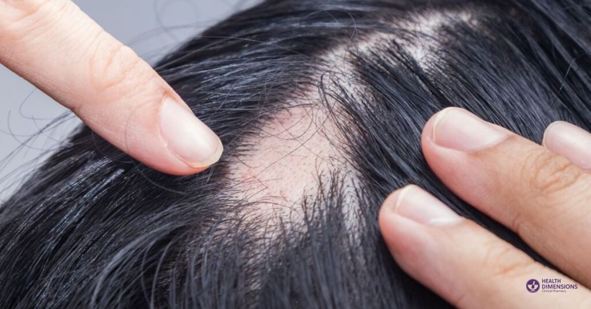 androgenic-alopecia-microneedling-hair-loss-michigan-compounding-pharmacy