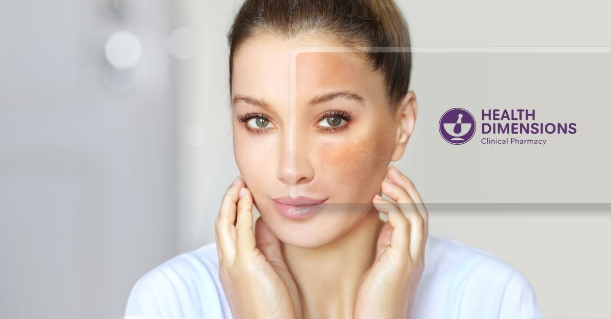 compounded-metformin-melasma-dermatology-skin-condition-cream-prescription-michigan-compounding-pharmacy