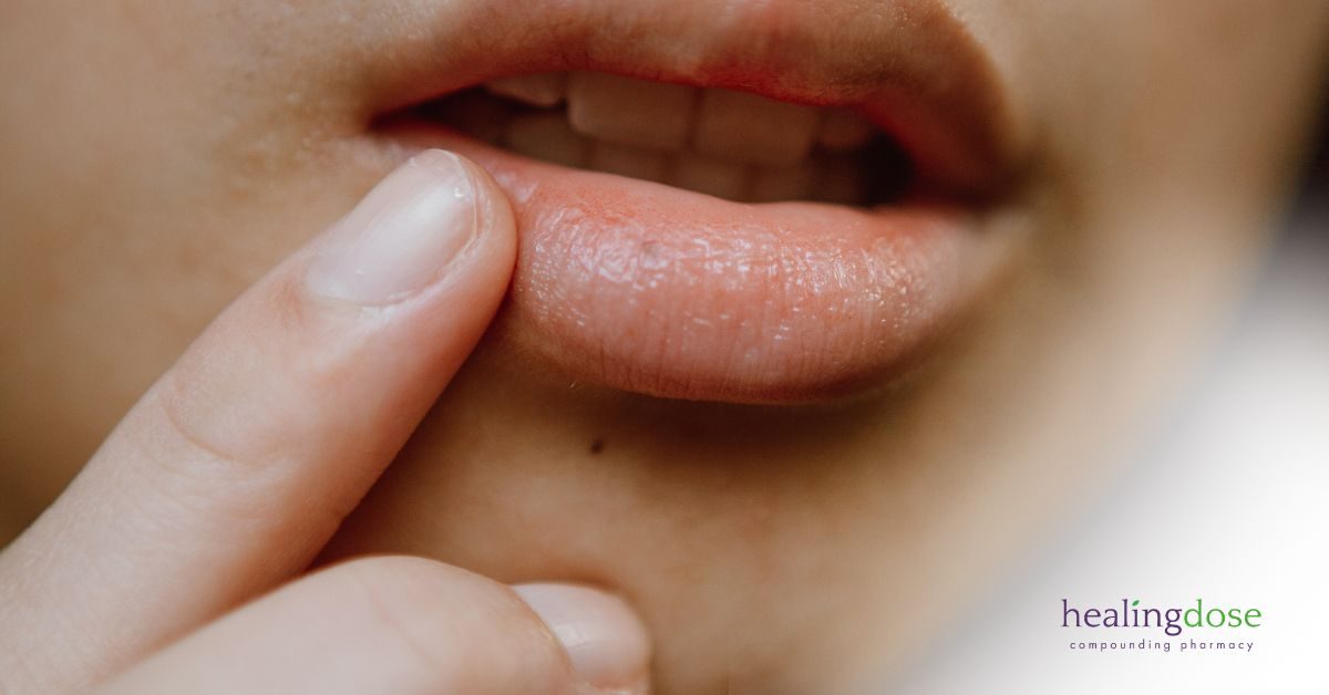 Dry Mouth in Sjögren's Syndrome & Other Conditions: A Breakthrough with Malic Acid/Fluoride (Sour Apple) Prescription Rinse